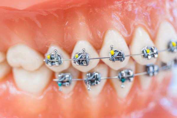 customized-orthodontic-treatment-systems 