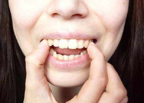 Làm răng hết hô tại nhà bằng việc dùng tay đẩy lực vừa phải lên răng