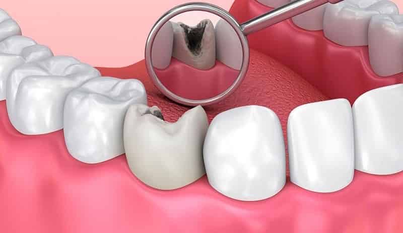 Đường ăn kiêng làm giảm nguy cơ sâu răng