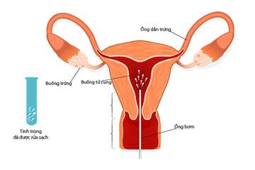 Khi nào nên thực hiện bơm tinh trùng vào buồng tử cung (IUI)?
