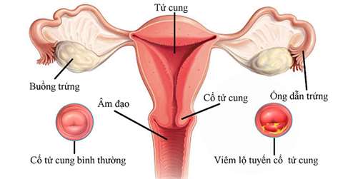 Viêm lộ tuyến cổ tử cung chính là căn bệnh gây nên bởi sự tấn công của những tế bào tuyến