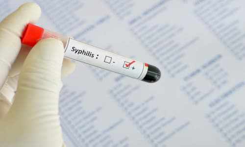 Xét nghiệm syphilis là gì