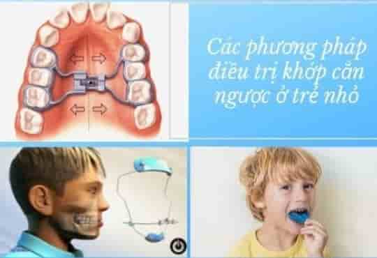 Cách điều trị Răng móm – Khớp cắn ngược tại Nha khoa Việt Nha