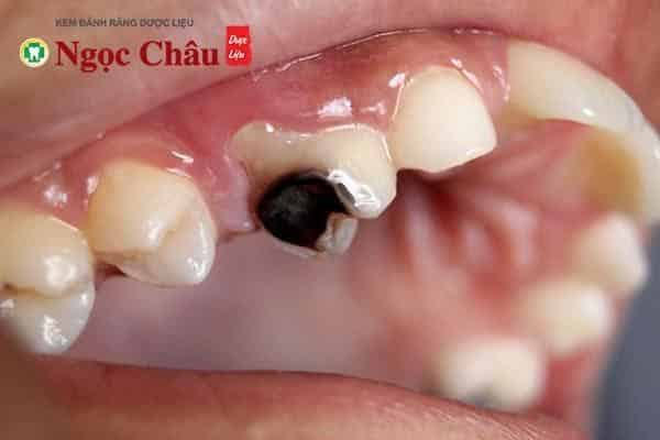 Sâu răng dẫn đến đau răng là vấn đề rất nhiều người gặp phải
