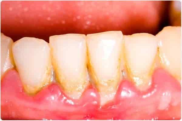 Nếu cao răng tích tụ quá nhiều sẽ gây ra những vấn đề răng miệng dai dẳng, khó chịu.