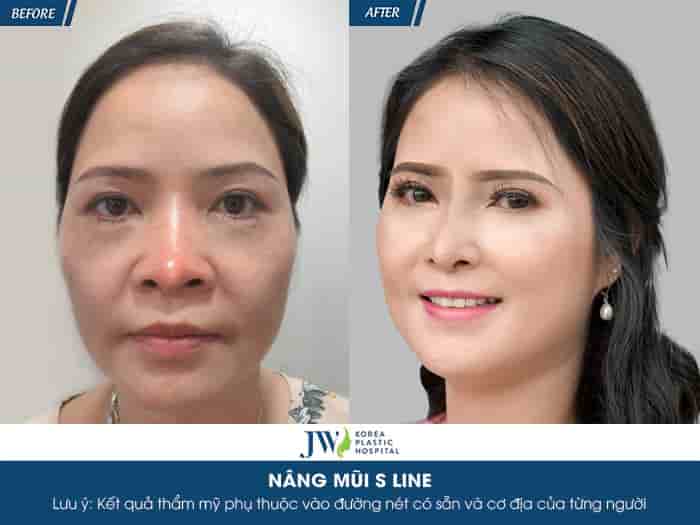 Nâng mũi S Line – Bí quyết tạo dáng mũi đẹp chuẩn Hàn